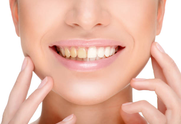 Complete smile makeover